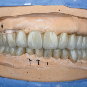 Heat Cure Acrylic Temps