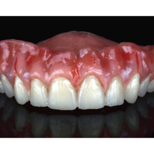 Aesthetic Denture