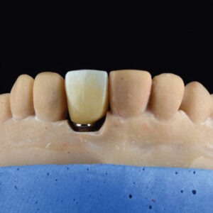 Implant Economy Zirconia