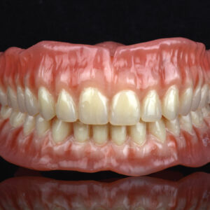 BPS Denture (Bio Functional Prosthetic System)
