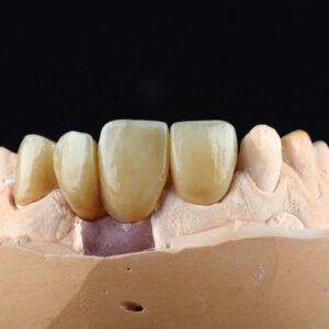 Implant Precise Zirconia