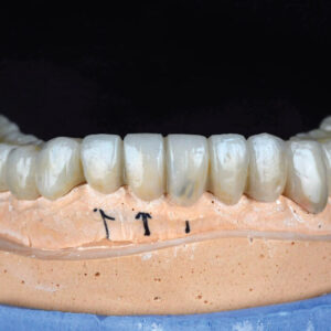 Heat Cure Acrylic Temps