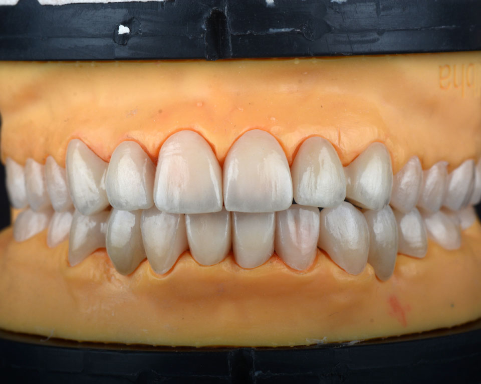 Zirconia - Image 5