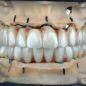 Implant-Supported Design